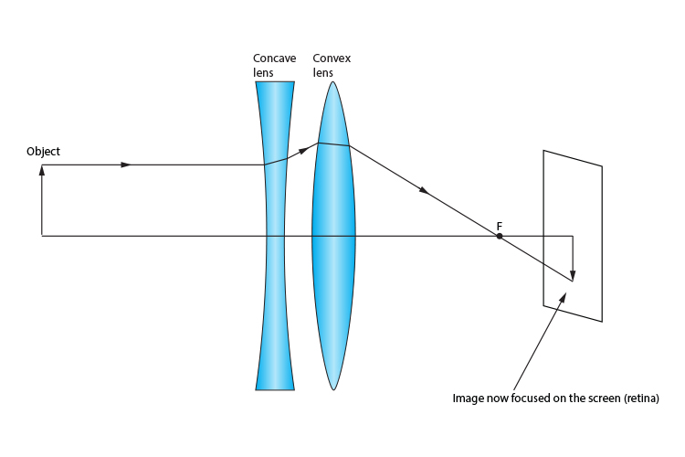 Concave lens used in conjunction with a convex lens to focus an image